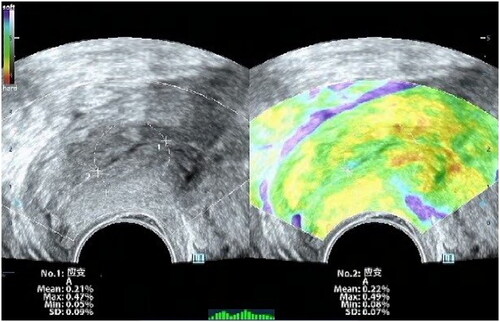 Figure 1. Schematic Of cervical elastography ROI localization with dual-mode grey-scale ultrasound images (left) and real-time elastography (right).