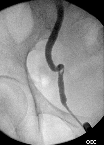 Figure 2 A right sided retrograde pyelogram showing severe hydroureter to the level of the vesicoureteric junction with associated filling defect within the distal ureter.