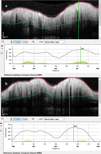 Figure 2. Optical coherence tomography retinal nerve fibre layer thickness (RNFL) at presentation showing increased thicknesses of the RNFL: (a) right eye and (b) left eye.