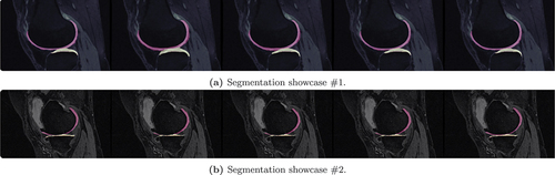 Figure 12. Segmentation results for femoral (FC) and tibial (TC) cartilage for the four instances of case #1 (left to right: Ground Truth, HOG, HOG & LBP, HOG & LBP & GLCM, all features). The first part of the figure illustrates a case of successful application of MV-KCS, while the second part presents in instance characterized by poor performance. In both cases, however, the positive effect of incorporating additional views is noticeable.