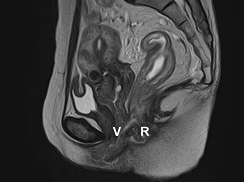 Figure 2 Abdominal MRI showed a continuous hyperintense area from the inside of the anal canal to the dorsal aspect of the vaginal wall on T2-weighted images.