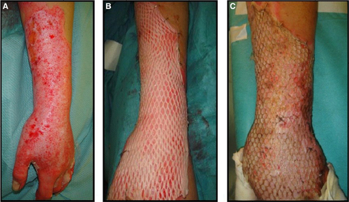 Figure 10 Autologous cryoreserved skin allografts meshed 3:1 used to cover a burn injury.