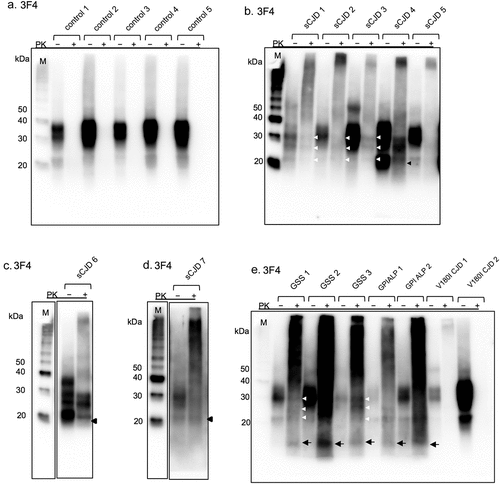 Figure 2. Western blot analyses of the formalin-fixed paraffin-embedded (FFPE) samples with the 3F4 anti-prion protein (PrP) antibody. (a) in control cases, proteinase K-untreated (PK [−]) samples show strong PrP signals at approximately 25–40kDa. Proteinase K-treated (PK [+]) samples show no signal. (b, c, d) in the sporadic Creutzfeldt–Jakob disease (sCJD) cases, PK-resistant PrP (PrPres) signals are observed with varied densities per case. In sCJD 1, 2, and 3, three PrPres bands are detected at 21–30 kDa (white arrowheads). sCJD 4, 6 and 7 also show three PrPres bands, but the unglycosylated PrPres are slightly wider at 19–21 kDa (black arrowheads). In sCJD 5, faint PrPres is detected at 21–30 kDa. In all sCJD cases, high molecular smear PrPres signals are observed with varied densities per case. (e) PK digestion reveals three bands of PrPres at 21–30 kDa (white arrowheads) in Gerstmann–Sträussler–Scheinker disease (GSS) 1 and 3, as well as low molecular weight bands at approximately 8 kDa (arrows) and strong high molecular weight smear bands. In GSS 2, a high molecular weight smear band and a band at approximately 8 kDa (arrow) are present. In glycosylphosphatidylinositol-anchorless prion disease (GPIALP) cases, PK digestion reveals smear bands from low to high molecular weight and low molecular bands at approximately 9 kDa (arrows). In V180I CJD cases, weak high molecular PrPres smear signals are observed in V180I CJD 1, PrPres signal are unclear in V180I CJD 2.