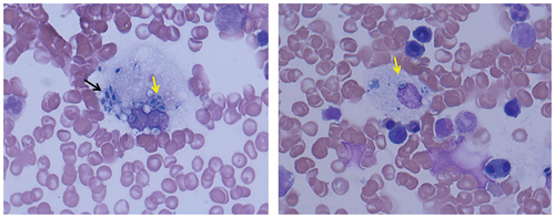 Figure 2. Histoplasma capsulatum (numerous, capsulated yeast cells) of phagocyte cells (arrow) in bone marrow smear (Wright’s staining, magnification 1,000×).