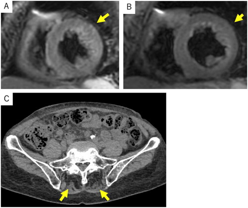 Figure 2. Cardiac MRI findings and CT findings.Cardiac MRI at the time of admission shows hyperintensity in the left ventricular sidewall on T2 image (A), which improved two weeks after the high-dose PSL initiation (B). CT shows atrophy of bilateral paraspinal erector spinae muscles (C).