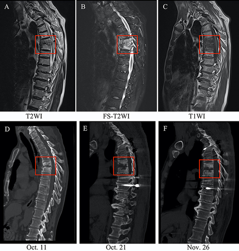 Figure 1 MRI and CT findings of the patient. (A–C) The MRI examination showed the destruction of vertebral at thoracic 4–7 (mainly 5–6) on October 11, 2022. (D–F) The CT examinations revealed the destruction of the vertebral bodies of thoracic 5–6 and cervical 6–7 at different times. (D–F) represent the CTs on October 11, October 21 and November 26, respectively. The destruction of the thoracic 5–6 was well improved when compared to the CT on admission. The red rectangles indicate the region of thoracic 5–6.