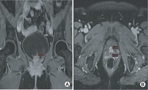 Figure 6. MRI pelvis (coronal and axial views) of nodular enhancing urinary bladder mass. (A & B) MRI pelvis (coronal and axial views) showing nodular enhancing soft tissue mass at the posterior segment of the urethra and urinary bladder base measuring 1.7 × 1.5 × 0.9 cm compatible with the biopsy-proven malignant melanoma.