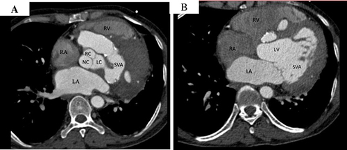 Figure 3 Cardiac CT in axial view (A and B) Showing left sinus of Valsalva aneurysm with suspicious communication in to interventricular septum.