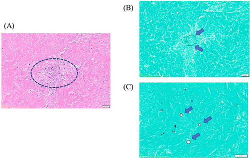 Figure 2 Morphology of a nodule in the upper lobe of the left lung. (A) The inner dotted line shows necrosis of lung tissue (hematoxylin and eosin staining, 400× magnification). (B) Arrows indicate rupturing spherical bodies (Grocott methenamine silver staining, 400× magnification). (C) Arrows indicate scattered endospores (Grocott methenamine silver staining, 500× magnification).
