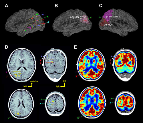 Figure 15 SEEG surgery planning. (A, B, C) 3D volume renderings of patient brains, with overlaid labels of electrode locations defined in stereotactic space. (D) Axial and coronal planar representations of patient T1-weighted brain image, with electrode paths J and K highlighted. Epileptogenic zones are labeled as J6, J7, K6, and K7. (D) Comparable axial and coronal planes of a co-registered PET volume: green labels correspond to lesser metabolic areas. Copyright © 2018. Reproduced with permission from Wang J, Wang Q, Wang M, et al. Occipital lobe epilepsy with ictal fear: evidence from a stereo-electroencephalography (sEEG) case. Front Neurol. 2018;9:644.77