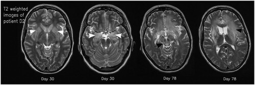 Figure 3. Axial T2 weighted images of patient D2 on days 30 and 78. Typical signal increase of the basal ganglia (white arrowheads) and the amygdala/hippocampus (white arrows) as well as hyperintensity in the mesencephalon (black arrow) and white matter (black arrowhead) is visible.