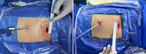 Figure 3 Location and details of the incisions. (A) A 2.5 cm utility incision was made in the 4th intercostal space, and a 5 mm trocar was placed in the 7th intercostal space. (B) A 16 Fr drainage tube was inserted into the 7th intercostal space.