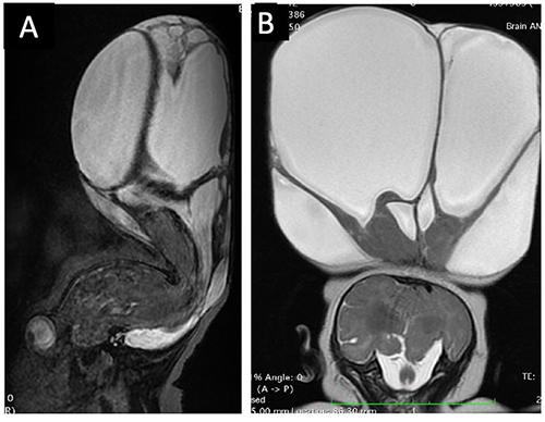 Figure 2 MRI Imaging of the lesion. (A) Sagittal view; (B) Coronal view. Hyperdensity showing the fluid cele, with hypodensity of the parenchyme denoting brain tissue.
