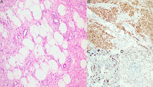 Figure 4 Pathological pictures of the lesion. (A) Hematoxylin/eosin analysis showed infiltration of foamy cells and scattered giant cells (x200). CD68-immunostaining (B), Ki67- immunostaining (C) and TFE3- immunostaining (D) of the xanthomas presented positive (x200).