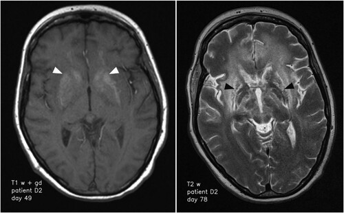 Figure 2. Transformation of the basal ganglia and respective changes on MR imaging over time. High signal of basal ganglia on T1 weighted imaging on day 49 after symptom onset (left; white arrowheads) and structural damage to the basal ganglia 72 days after symptom onset (right; black arrowheads).