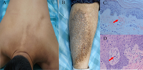 Figure 1 Clinical and pathological features of PCA patients. (A) Typical rippled hyperpigmented patches on the back and (B) papular lichenoid on the shin. (C) Congo red positive amyloid deposits in PCA patients (Congo Red stain, x200, arrow). (D) The amyloid deposits in the papillary dermis (H&E, x400, arrow).