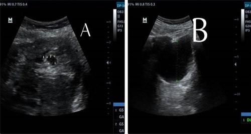 Figure 1 Showing a trans abdominal ultrasound scan showing right adnexal mass (A) and free fluid in the Cul-de-sac (B).