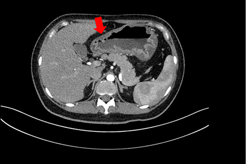 Figure 1 Abdominal contrast-enhanced computed tomography showing thickening of the gastric body and antrum wall and exudation around the gastric antrum (Red arrow: lesion).