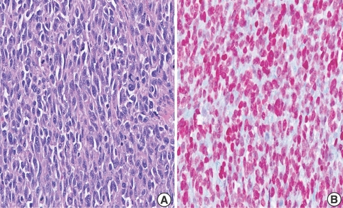 Figure 8. Radical cystourethrectomy showing highly atypical epithelioid melanoma cells. (A & B) Radical cystourethrectomy showing highly atypical epithelioid melanoma cells of the urinary bladder 40× (left), tumor cells demonstrate positivity for SOX10 (right).