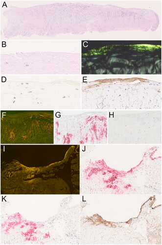 Figure 1. Amyloid in the annular ligament. Amyloid in the annular ligament (A-cross sectional area) was found as band like-deposits immediately below the surface (B–E; serial sections), as well as dot-like or patchy deposits within the matrix (F–H; serial sections). The band-like deposits at the surface were immunonegative for transthyretin (D) and immunoreacted with an antibody directed against fibrinogen (E). The dot-like and patchy deposits within the matrix stained for transthyretin (H). In 13 cases, both transthyretin- and fibrinogen-immunoreactive amyloid deposits were present within the same resection specimen (I–L; serial sections). Haematoxylin and eosin (A, B), Congo red in polarised light (C), Congo red in fluorescence microscopy (F, I), anti-transthyretin antibody (D, H, K), anti-fibrinogen antibody (E, L), anti-amyloid P component (J). Original magnifications 2-fold (A), 100-fold (I-L), 200-fold (F–H), and 400-fold (B–E).