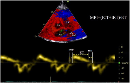 Figure 1. The tissue Doppler curve showed the calculation of the MPI index. MPI: myocardial performance index; ICT: isovolumetric contraction time; IRT: isovolumic relaxation time; ET: ejection time; LV: left ventricle; LA: left atria; RV, right ventricle; RA, right atria; DAO: descending aorta.