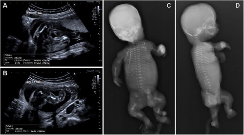 Figure 1. Instrumental examination at the first pregnancy. Ultrasounds at 21 weeks (A, B) show severe, generalized micromelia. X-rays after abortion (C, D) show rhizo-mesomelic micromelia with reduced mineralization of the long bones and spurred metaphyses, short ribs, and platyspondyly.