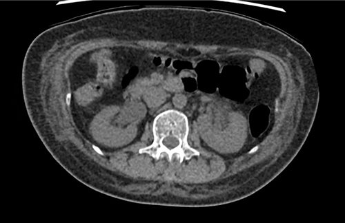 Figure 1 An axial section from a non-contrast abdominal CT scan showing severe bilateral hydronephrosis.