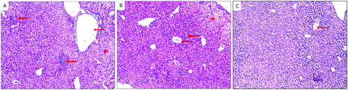 Figure 8. H&E-stained liver sections of (A) group I showing severe inflammatory cellular infiltrates (thick arrow) together with dilated central vein (thin arrow) and areas of hydropic degeneration of the hepatocytes (arrowhead) (×100). (B) Group II showing moderate inflammatory cellular infiltrates (thick arrow) together with moderately dilated central veins (thin arrow) and areas of hydropic degeneration of the hepatocytes (arrowhead) (×100). (C) Group III showing mild inflammation with normal central veins (thin arrow) (×100).