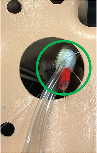 Figure 14 Captured image of successful positioning of the inferior suction base near the apex of the heart, using Introducer Mechanism II.