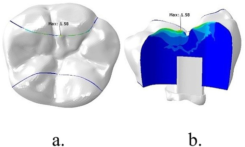 Figure 3 Stress distribution of interface between enamel and packable composite, after vertical loading on lower first molar with MOD cavity+Polyethylene fiber reinforced composite: (a) occlusal view, (b) buccal view of packable composite.