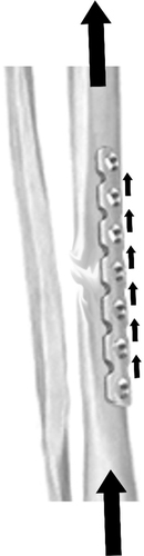 Figure 4 When a fracture is treated with open reduction and internal fixation, forces applied through the bone are transmitted through the plate.