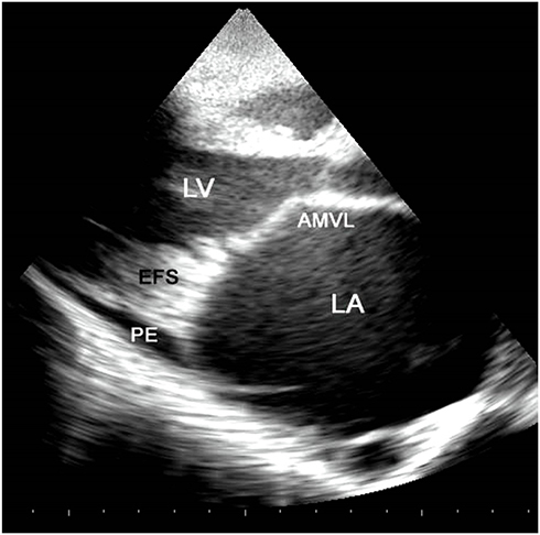 Figure 2 LAP view showing huge left atrium (LA), endomyocardial fibrous shelf (EFS), anterior mitral valve leaflet (AMVL), pericardial effusion (PE), and left ventricle (LV).