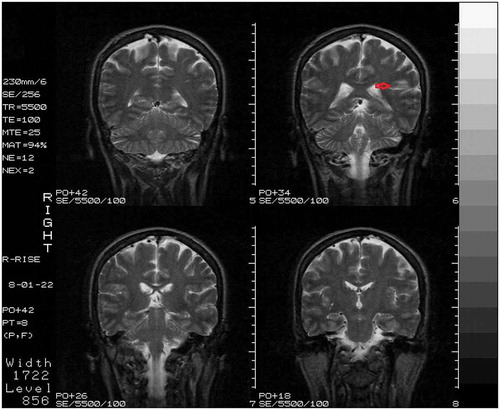 Fig. 1. Coronal section of MRI performed on the day after admission, showing an ischemic stroke restricted to the left claustrum (red arrow).