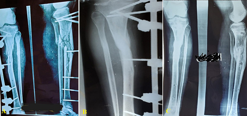 Figure 1 Open segmental tibial shaft fracture treated by external fixation method; (A) plain X-ray after injury (AP view and lateral views), (B) X-ray (AP view) 3 months after the injury, (C) X-ray (AP and lateral views) 6 months after the surgery.