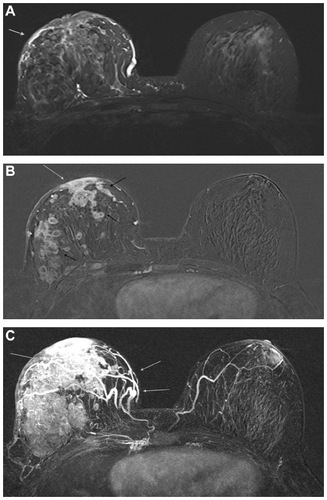 Figure 4 A 53-year-old woman with multiple lesions of the right breast, as seen on a breast ultrasound, proved to be invasive ductal carcinoma at pathology. She underwent a breast MRI to determine the extent of the disease and the multicentricity.