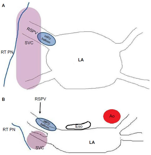 Figure 3 Location of structures prone to injury during balloon-based AF ablation.
