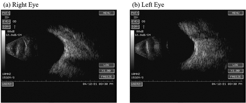 Figure 3. Ultrasonographic images of the eyes revealed vitreous opacity and staphyloma of the posterior sclera in both eyes, but no obvious retinal detachment.