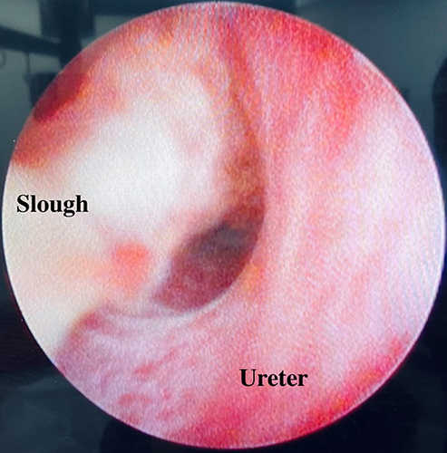 Figure 4 Photograph taken during left sided rigid ureteroscopy showing a large white sloughy debris partially occluding the vesicoureteric junction.