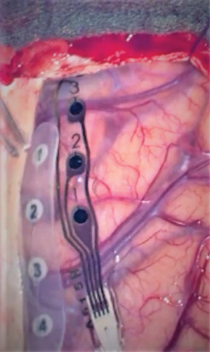 Figure 1. ECoG electrodes in the surgical field.