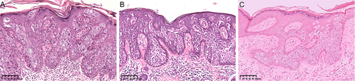 Figure 1 HE staining: A large number of nested Paget-like cells were found throughout the epidermis. The cytoplasm of tumor cells is rich, transparent and vacuolar. The basement membrane was intact, and a large number of lymph and plasma cells were infiltrated at the epidermal dermal junction. (A) Case1 (200X), (B) Case2 (200X), (C) Case3 (200X).