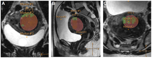 Figure 1 MR-HIFU treatment planning with superimposed MRI in three planes, such as coronal (A), sagittal (B), and transversal (C); pretreatment T2-weighted planning MR images show a uterine fibroid with low signal intensity. Red circles indicate the target volume for HIFU treatment as defined by the borders of the UF with a safety margin; green ellipsoids indicate the anticipated volumes of sonication.