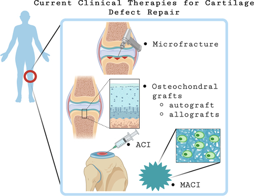 Figure 1. Schematic summary of therapies for cartilage defect regeneration that are FDA approved and practiced in the clinic. Treatments like microfracture and autografts are the current gold standard for cartilage defect repair. ACI and MACI have reached FDA approval and can be used for large defect repair.