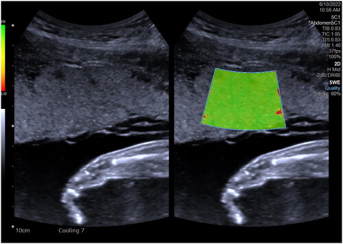Figure 1. Example of reverberation artifacts of placenta. Green and red areas are artificially set colors; green area indicates precise range of stiffness measurements. In 2D-SWE, artifacts can be identified and avoided on color maps.