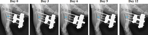Figure 3 These postoperative radiographs show a tibia that underwent TTT. (A) The corticotomy and external fixator sites (arrow) were confirmed on radiographs immediately after surgery. (B) After 3 days of medial transport, the displacement of the corticotomized fragment was evident. (C) At day 6, the corticotomized fragment reached its maximum displacement. (D and E) This was followed by 6 days of lateral distraction, at the end of which (day 12) the corticotomized fragment returned to its original position and the external fixator was removed.