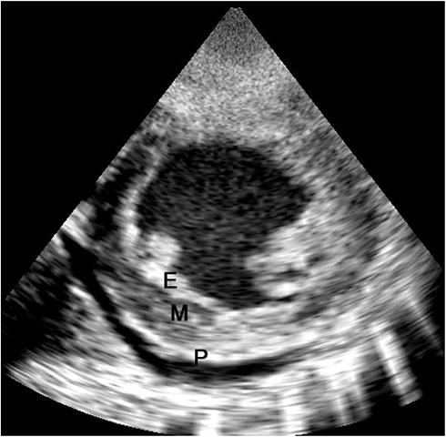Figure 4 Short axis view showing endocardial fibrosis (E) engulfing the posterior papillary muscle. Calcification of the pericardium and pericardial effusion (P) are seen.