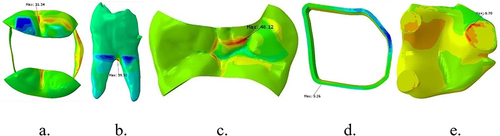 Figure 5 Stress distribution after vertical loading on lower first molar with MOD cavity and e-glass fiber reinforced composite on (a) enamel, (b) dentin, (c) packable composite, (d) e-glass fiber wallpapering the cavity wall, and (e) e-glass fiber wallpapering the cavity floor.