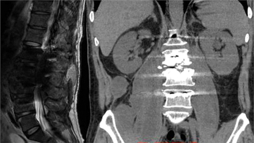Figure 4 Lumbar CT and MRI: bilateral psoas major abscess formation, center liquefaction necrosis. Abnormal signals in the subcutaneous soft tissue of the lower back were considered inflammatory lesions and local sinus formation.