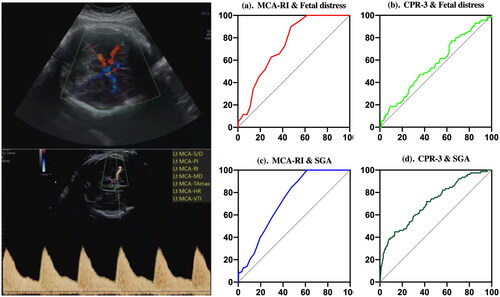 Figure 1. (a and b). Best ROC values of fetal distress predicted by the fetal middle cerebral artery resistance index (MCA-RI) and cerebroplacental ratio 3 (CPR-3); (c and d). Best ROC values of small for gestational age (SGA) predicted by MCA-RI and CPR-3. X axis refers to 100%-Specificity%; Y axis refers to Sensitivity%.