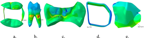 Figure 7 Stress distribution after lateral loading on lower first molar with MOD cavity and e-glass fiber reinforced composite on (a) enamel, (b) dentin, (c) packable composite, (d) e-glass fiber wallpapering the cavity wall, and (e) e-glass fiber wallpapering the cavity floor.
