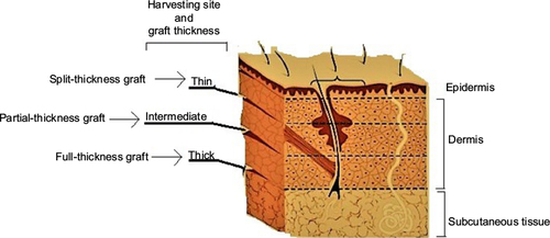 Figure 7 Classification of skin allografts according to their thickness and site of dermatome cleavage.